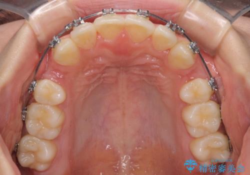 短期間で口元の突出感を改善 ワイヤー装置での抜歯矯正の治療中