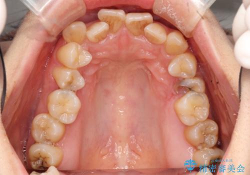 【がたつき・深い噛み合わせでお悩みの方必見】抜歯矯正症例(審美ワイヤー矯正)の治療前