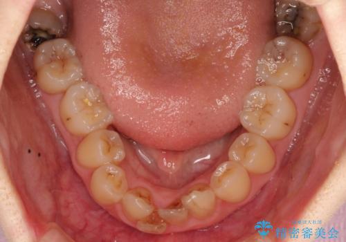 【がたつき・深い噛み合わせでお悩みの方必見】抜歯矯正症例(審美ワイヤー矯正)の治療前