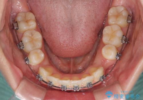 短期間で口元の突出感を改善　ワイヤー装置での抜歯矯正の治療中
