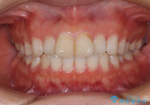 前歯の捻れを改善　インビザラインによる矯正治療の症例 治療前