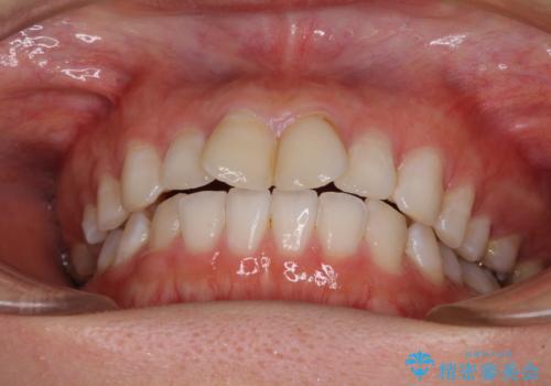 前歯の捻れを改善 インビザラインによる矯正治療の治療前