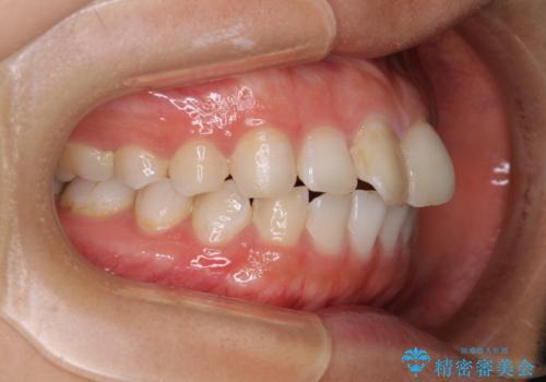 前歯の捻れを改善　インビザラインによる矯正治療の治療前
