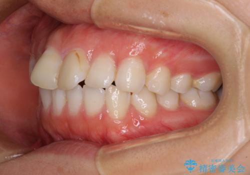 前歯の捻れを改善　インビザラインによる矯正治療の治療前
