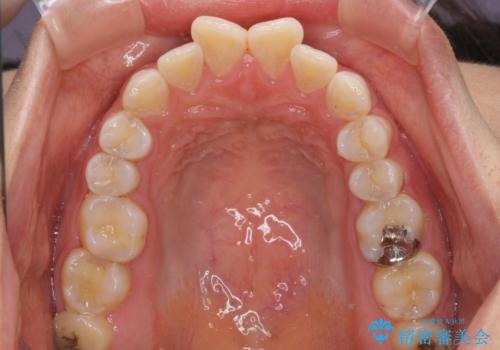 前歯の捻れを改善 インビザラインによる矯正治療の治療前