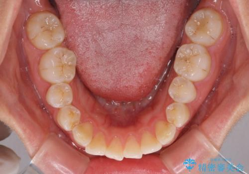 前歯の捻れを改善 インビザラインによる矯正治療の治療前