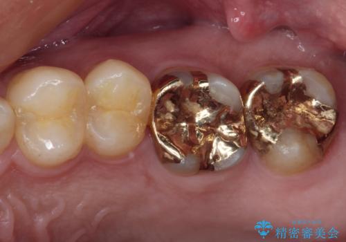 強い咬合力で生じた亀裂からむし歯に　奥歯のゴールドインレー治療の治療後