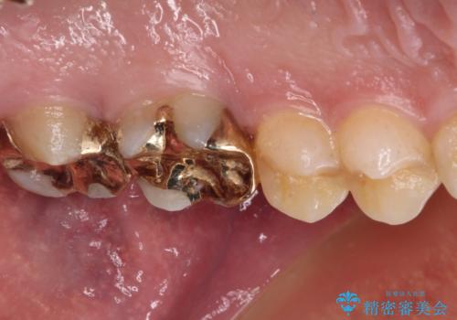 強い咬合力で生じた亀裂からむし歯に 奥歯のゴールドインレー治療の治療後