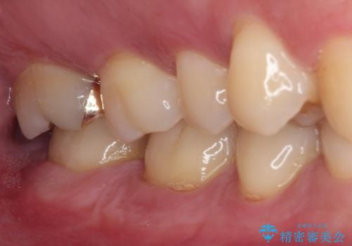 強い咬合力で生じた亀裂からむし歯に 奥歯のゴールドインレー治療の治療後