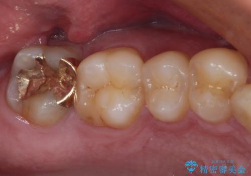 強い咬合力で生じた亀裂からむし歯に 奥歯のゴールドインレー治療の治療後