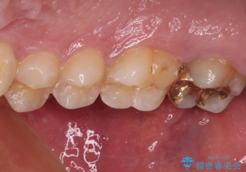 強い咬合力で生じた亀裂からむし歯に　奥歯のゴールドインレー治療の治療後