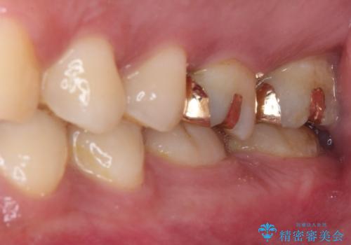 強い咬合力で生じた亀裂からむし歯に 奥歯のゴールドインレー治療の治療後
