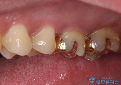 強い咬合力で生じた亀裂からむし歯に　奥歯のゴールドインレー治療