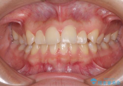 カリエール・ディスタライザーとインビザラインを用いた奥歯の咬み合わせ改善の症例 治療前