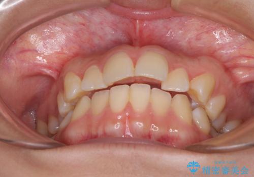 カリエール・ディスタライザーとインビザラインを用いた奥歯の咬み合わせ改善の治療前