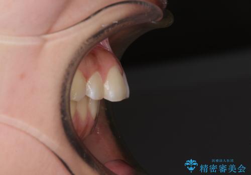 カリエール・ディスタライザーとインビザラインを用いた奥歯の咬み合わせ改善の治療前