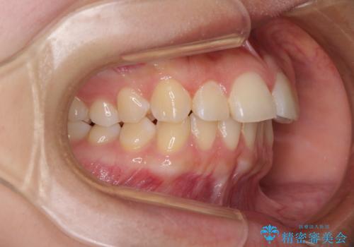カリエール・ディスタライザーとインビザラインを用いた奥歯の咬み合わせ改善の治療前