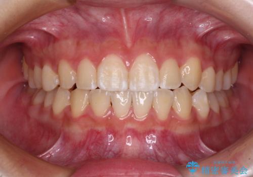 むし歯になりやすい奥歯 補助装置で一気に解決の症例 治療後