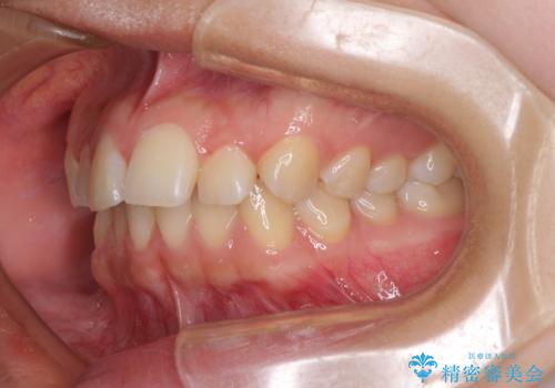 カリエール・ディスタライザーとインビザラインを用いた奥歯の咬み合わせ改善の治療前