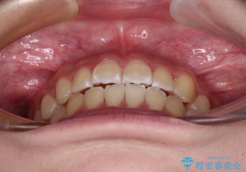 むし歯になりやすい奥歯 補助装置で一気に解決の治療後