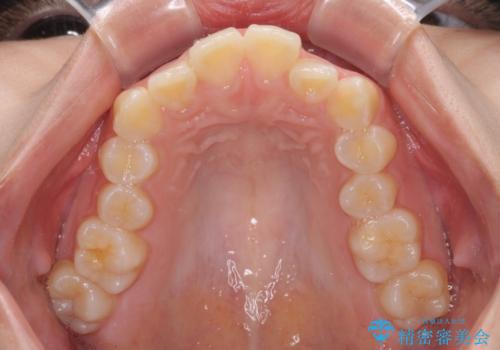 カリエール・ディスタライザーとインビザラインを用いた奥歯の咬み合わせ改善の治療前