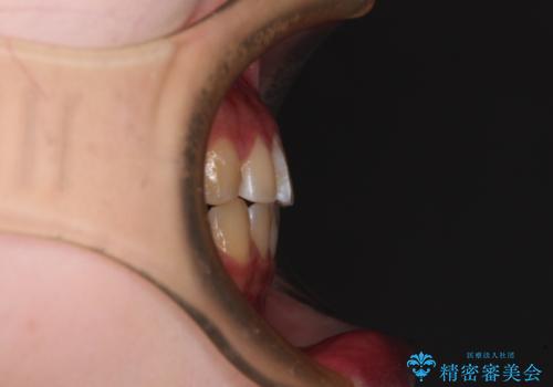 むし歯になりやすい奥歯 補助装置で一気に解決の治療後