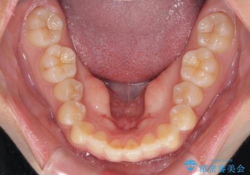 カリエール・ディスタライザーとインビザラインを用いた奥歯の咬み合わせ改善の治療前