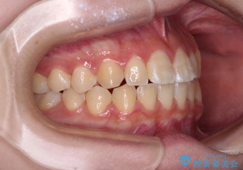 むし歯になりやすい奥歯 補助装置で一気に解決の治療後