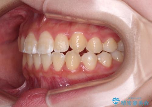 むし歯になりやすい奥歯 補助装置で一気に解決の治療後