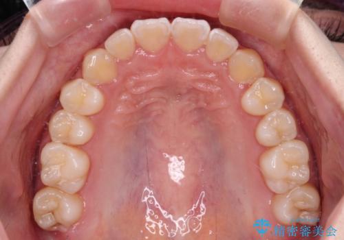 むし歯になりやすい奥歯 補助装置で一気に解決の治療後
