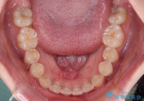 むし歯になりやすい奥歯 補助装置で一気に解決の治療後