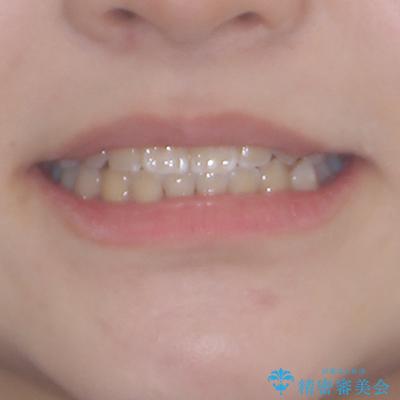 むし歯になりやすい奥歯 補助装置で一気に解決の治療後(顔貌)