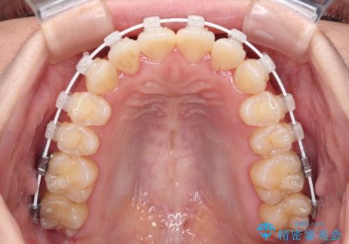 ワイヤー矯正で楽して治療　前歯のデコボコを短期間で改善の治療中