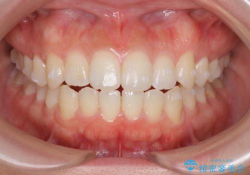 前歯のすれ違い インビザラインで行うマウスピース矯正の治療中