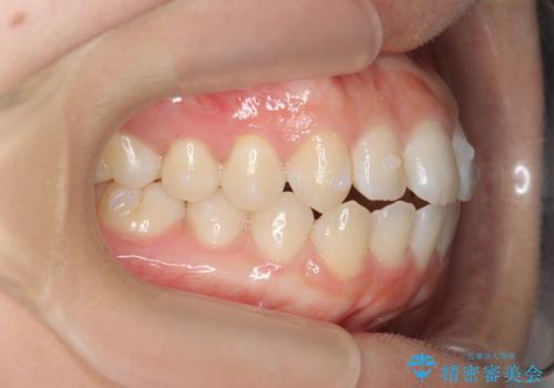 前歯のすれ違い インビザラインで行うマウスピース矯正の治療中