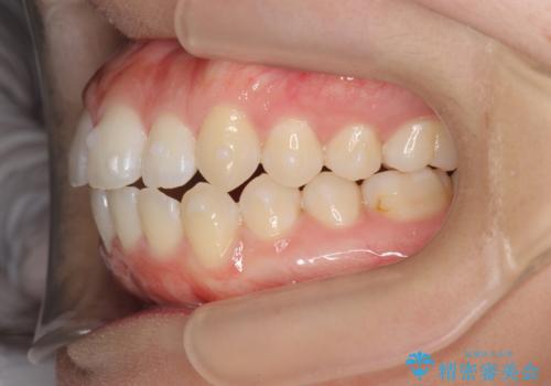 前歯のすれ違い　インビザラインで行うマウスピース矯正の治療中