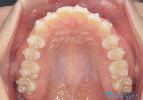 前歯のすれ違い インビザラインで行うマウスピース矯正の治療中