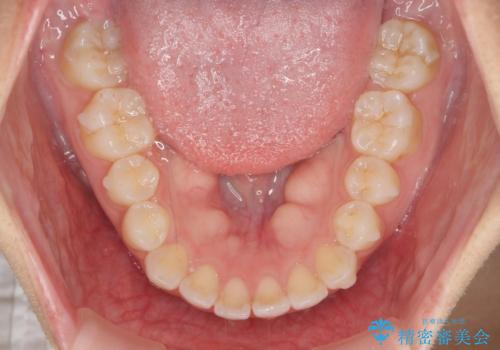 前歯のすれ違い インビザラインで行うマウスピース矯正の治療中