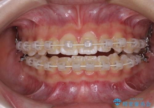 むし歯になりやすい奥歯 補助装置で一気に解決の治療中
