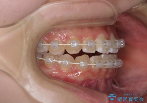 むし歯になりやすい奥歯　補助装置で一気に解決の治療中
