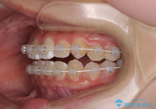 むし歯になりやすい奥歯　補助装置で一気に解決の治療中
