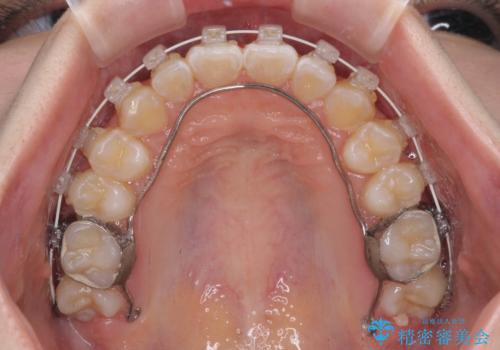 むし歯になりやすい奥歯 補助装置で一気に解決の治療中