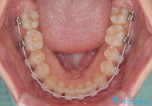 むし歯になりやすい奥歯 補助装置で一気に解決の治療中