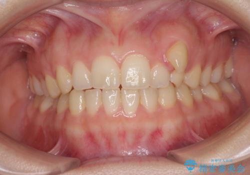 気になる残存乳歯と八重歯　ワイヤー矯正を併用したインビザライン治療の症例 治療前