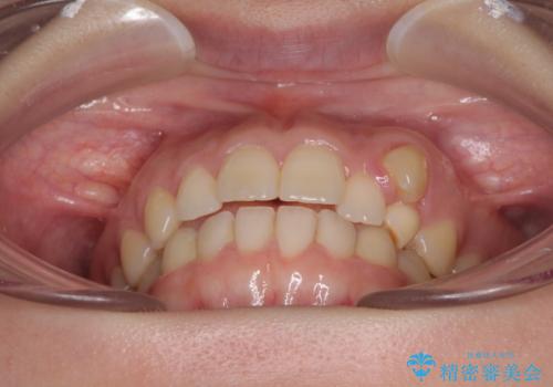 気になる残存乳歯と八重歯 ワイヤー矯正を併用したインビザライン治療の治療前