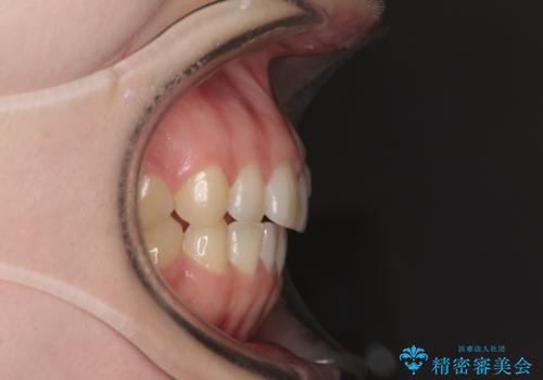 気になる残存乳歯と八重歯 ワイヤー矯正を併用したインビザライン治療の治療前