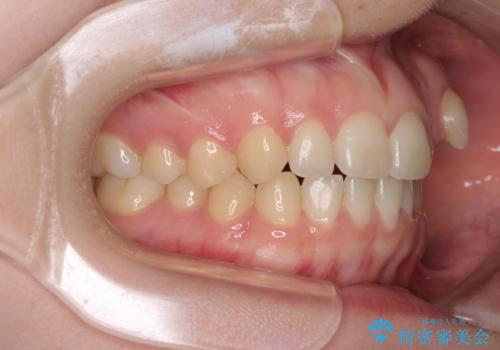 気になる残存乳歯と八重歯 ワイヤー矯正を併用したインビザライン治療の治療前