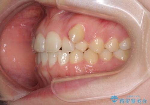 気になる残存乳歯と八重歯 ワイヤー矯正を併用したインビザライン治療の治療前