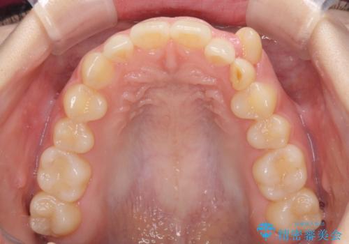 気になる残存乳歯と八重歯　ワイヤー矯正を併用したインビザライン治療の治療前