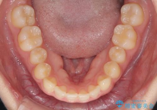 気になる残存乳歯と八重歯 ワイヤー矯正を併用したインビザライン治療の治療前